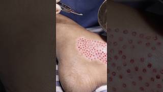 Vitiligo Treatment at Skinaa Clinic  A Patients Experience viral shortsfeed [upl. by Ocsicnarf]