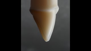 All Ceramic Crown Preparation for Emax and Zirconia [upl. by Gradey]