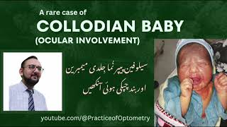 Collodion Baby  Collodion Syndrome  Congenital Eye Disorder  Ophthalmology  Optometry EyeCare [upl. by Banna]