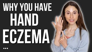 THIS IS WHY YOU HAVE HAND ECZEMA 🖐 DERMATOLOGIST DrDrayzday [upl. by Mehs]