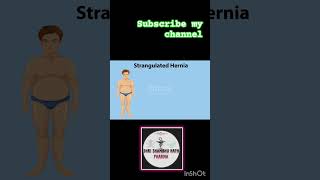 Animation of Strangulated hernia with explanation4k 3danimation trending shortvideo doctor [upl. by Elayor631]