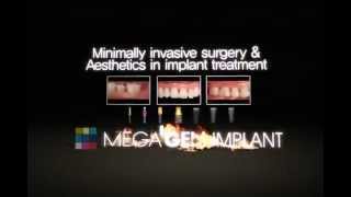 MegaGen Implant [upl. by Airot]