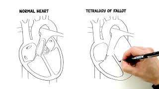 What is Tetralogy of Fallot [upl. by Aika]