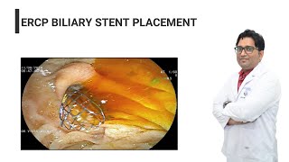 ERCP biliary metallic stent placement  ercp metallicstent jaundice [upl. by Eca901]