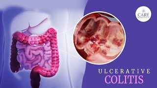 What is Ulcerative Colitis Causes Symptoms Diagnosis Treatment for Ulcerative Colitis [upl. by Lednahs]