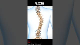 Scoliotic Spine Correction Short Video  spine shorts [upl. by Notrab]