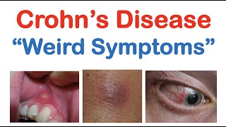 Crohn’s Disease Weird Symptoms  Atypical Clinical Features  Skin Mouth Joints Organ Systems [upl. by Cairistiona715]