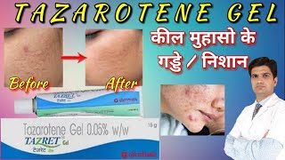 Tazarotene gel  Tazarotene cream 01  Tazarotene gel 005 reviews tazret 005 gel  tazret gel [upl. by Grane384]