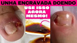 como aliviar dor de unha encravada e inflamada [upl. by Soisinoid]