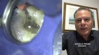 Endodontia de dente com perda de tecido coronário e canal obstruído [upl. by Accisej229]