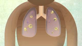 How The Body Reacts To Tuberculosis [upl. by Suixela]