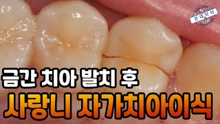 크랙 치아 발치 후 임플란트 대신 사랑니 자가치아이식 수술 Wisdom tooth transplant [upl. by Deeyn]