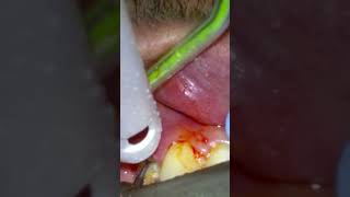 Nasty Tooth Extraction THE TOOTH KEEPS BREAKING extraction extractionsatisfaction [upl. by Ax]