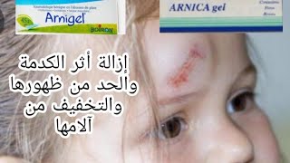 ضروري من حملها في حقيبة يدك أينما ذهبت،arnigelالحل الوحيد والفعال لتفادي الكدمات وعلاجها بسرعة [upl. by Higgs]