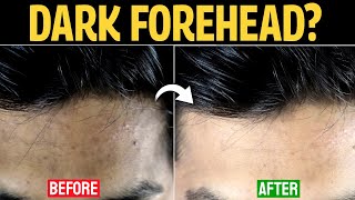 How To Get Rid of Dark Forehead Proven Solution  Forehead Black Removal [upl. by Indira504]