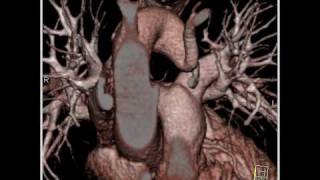 Cardiac Compression of trachea by right aortic arch with attempted double aortic arch 3 of 5 [upl. by Offen]