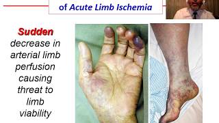 Acute Ischemia  OVERVIEW [upl. by Dihgirb]