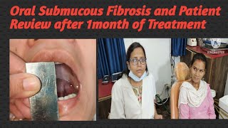 Oral Submucous Fibrosis and Patient Review after 1month of Treatment [upl. by Ait248]