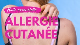 Allergie cutanée et huile essentielle [upl. by Annoyk]