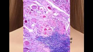 Anaplastic thyroid cancer pictures [upl. by Ancalin]