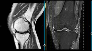 Mucoid degeneration of lateral meniscus in 86 year old [upl. by Zeena736]