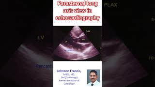 Parasternal long axis view in echocardiography [upl. by Ganny595]