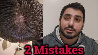 Hair Loss Mistakes  My Hair Journey  FAILED [upl. by Middlesworth]