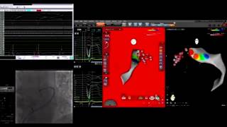 Great cardiac vein GCV VTAblation in coronarySinus EPStudy [upl. by Yesnik105]