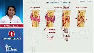 Fracturas Generalidades  Consolidación ósea TRAUMATOLOGÍA QXMEDIC [upl. by Ecnarret]