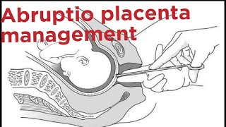 Abruptio placenta management [upl. by Petracca752]