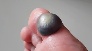 i woke up with this on my toe [upl. by Rimola]