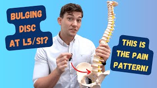 L5S1 Bulging Disc Pain Pattern Explained [upl. by Deer331]