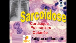 Sarcoidose pulmonaire articulaire renale hepatique cutanée ophtalmologique [upl. by Ellswerth]