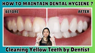 Teeth Deep Cleaning at Dentist 🦷 Taking Care of your Teeth  Cleaning Yellow teeth by Dentist🌸teeth [upl. by Loriner]