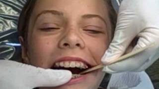 How A Herbst Appliance Is Placed Manley Orthodontics [upl. by Jewelle]