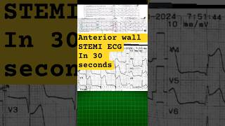 Anterior wall STEMi ecg reading in 30 seconds ecganalysis [upl. by Serica]