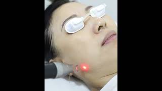 PICO Hybrid Laser Singapore v2  Ace MediAesthetics Clinic [upl. by Alemrac]