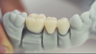 3D Printing in the Dental Laboratory fabrication of temporary crowns amp bridges with Freeprint® temp [upl. by Aikemaj874]