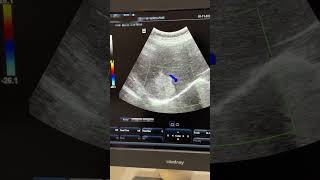 Hepatic Mets  Hemangioma ultrasound sonography hemangioma liver mets hepatic [upl. by Hadrian]