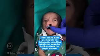 Free Cleft Surgery at gsrhospital hyderabad india cute baby cutebaby babyshorts babylove [upl. by Labaw]