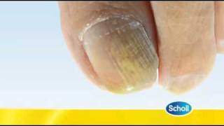 Fungal Nail Condition by Scholl [upl. by Jessen881]