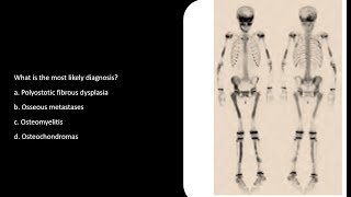 Fibrous Dysplasia MCQs SCFHS bonescan nuclearmedicineMCQ nuclearmedicine frcr bonescan [upl. by Ginelle448]