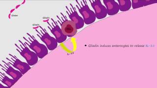 Celiac Disease Pathogenesis Described Concisely and in Detail [upl. by Anabal]