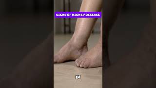 Signs of Kidney Disease [upl. by Donelu]