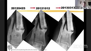 From Pain to Progress A Remarkable Journey of Correcting Complex Distal Tibia NonUnion [upl. by Appolonia]