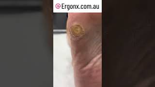 Huge satisfying corn and callus removal by podiatrist These are very painful to walk on [upl. by Okoyik]