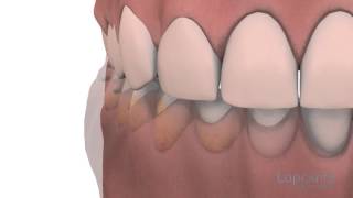 Gingivoplastie et gingivectomie  Centres dentaires Lapointe [upl. by Fairley660]