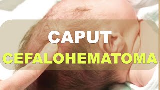 Caput Succedaneum Cefalohematoma Hemorragia Subgaleal Explicación [upl. by Yolane]