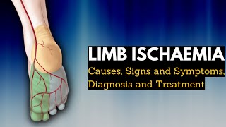 Limb Ischaemia  Causes Signs and Symptoms Diagnosis and Treatment [upl. by Notkcorb]