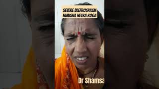 A Case of Blepharospasm Nimisha Netra Roga niajaipur dr Shamsa fiaz [upl. by Karmen]